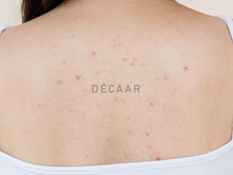 Sự cọ xát từ quần áo